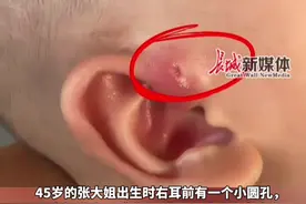 那不是“有福”是有病！耳朵上的“聪明洞”原来是胚胎发育不全，胚胎时期发育不全没有闭合所致，如遇感染需切开排脓。#耳仓  #健康视频封面