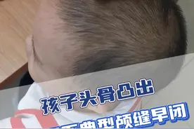 孩子头骨凸出，可能是不典型颅缝早闭，需要排查 #颅缝早闭 #医学科普 #儿童脑科小米大夫#听医生一句劝 #硬核健康科普行动视频封面