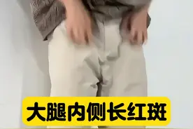 大腿内侧长红斑，天热出汗非常痒，越抓越痒#股癣怎么办#医学科普#男性健康 #真菌感染#酮康唑乳膏视频封面
