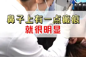 鼻子上有一点瘢痕就很明显 #医学科普 #疤痕 #疤痕疙瘩视频封面
