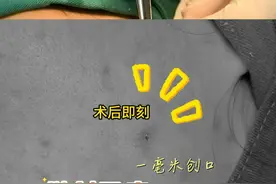 解锁无痕修复，微创手术轻松去除面部皮脂腺囊肿 面部皮脂腺囊肿，是一种常见的皮肤问题，通常表现为皮肤表面的小包块，虽然它一般无害，但可能会影响外观，甚至引发感染或炎症。对于很多人来说，去除皮脂腺囊肿既是美观需求，也是健康考虑。
传统的手术方式可能会留下较明显的疤痕，而现在，微创手术提供了一种更加温和的治疗方法。微创手术通过小切口进入，采用先进的技术精确去除囊肿，同时对周围组织的损伤极小，术后恢复也非常迅速。
为什么选择微创手术？
恢复快速：微创手术的切口小，伤口愈合快，一般无需住院，术后第二天即可恢复正常生活。
疤痕小：相比传统手术，微创手术留下的疤痕非常微小，甚至有些人术后几乎看不见痕迹。
效果持久：通过专业手术，皮脂腺囊肿根除的同时，也避免了复发的风险，保持长久的美丽。
术后护理小贴士：
保持伤口清洁干燥，避免感染。
避免剧烈运动，给伤口充分的恢复时间。
按照医生建议进行复查，确保术后效果最佳。
面部皮脂腺囊肿不再是烦恼，微创手术让你拥有光滑无瑕的肌肤，轻松告别“包块”困扰！如果你也有类似困扰，不妨考虑一下微创手术，效果值得期待！
#皮脂腺囊肿 #皮脂腺囊肿切除 #粉瘤 #抖出健康知识宝藏  #皮肤科视频封面