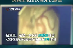 画面高能！女子长期腹痛，从肠里取出20厘米长蛔虫#江苏dou知道 #政媒原创作者联盟 视频封面