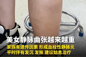 有遗传因素，形成血栓性静脉炎，平时伴有发沉，建议姑息治疗。视频封面