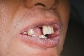 牙齿摇摇晃晃？千万不能等它自己掉！ 如果是牙周炎引起的牙齿松动，会导致牙槽骨吸收，如果不早点治疗，可能导致骨头吸收严重，牙齿会逐渐脱落，甚至给种植造成困难。#种植牙 #种牙  #硬核健康科普行动视频封面