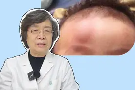 孩子头上摔了一个包，家长别去揉，也别涂油了，立即这样正确处理！#医学科普 #健康 #科普 #头皮血肿 #头上磕了个大包视频封面
