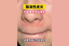 鼻翼两侧发红油腻还脱皮，这不是简单的#换季 干燥 #脂溢性皮炎用什么药 #护肤  #硬核健康科普行动   #女生必看视频封面