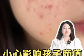青春期的孩子脸上出油多还长痘，别再乱洗脸了！ #痘痘  #油皮  #青春期孩子  #颜值 #黄芩洁面泡泡视频封面