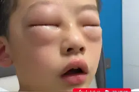 7月11日（采访），河南焦作，#男孩不情愿写作业揉眼半小时致双眼水肿  ，男孩妈妈：滴了眼药水，不让他写作业就好了视频封面