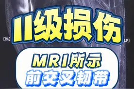 MRI所示前交叉韧带II级损伤 #医学影像 #医学生视频封面