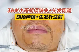 36岁小哥胡须缺失+头发稀疏，胡须种植+生发针注射 #胡须种植 #脱发 #头发稀疏 #江华医生团队视频封面