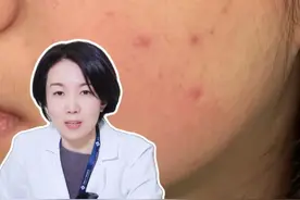 你的痘痘是哪个等级呢？ 脸上反复长痘的人，这条视频要看完，三甲皮肤科医生教你简单处理#痘痘 #痤疮 #黑头 #在抖音pick你的健康搭子 #脆皮大学生视频封面