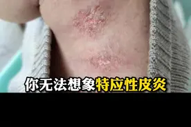 皮肤瘙痒，挠到破皮出血，#特应性皮炎 严重影响生活 怎么办 #皮肤 #科普 视频封面