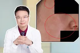 到了夏季，皮炎高发，身上长红疹红斑、痒得难受，试试这样处理；#皮肤科医生谢红付 #红付教授说敏痘 #皮炎湿疹视频封面