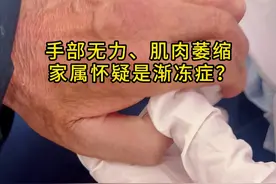 手部无力、肌肉萎缩 家属怀疑是渐冻症？ #渐冻症 #手肌肉萎缩 #运动神经元病  #肌力下降 #抖出健康知识宝藏视频封面