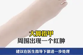 #脚指甲往肉里长怎么办 协和皮肤科主任教你正确处理方法！#医学科普 #皮肤科 视频封面