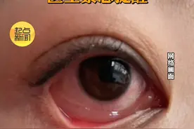 一夜接诊300多例！过敏性结膜炎高发！警惕！ #过敏视频封面