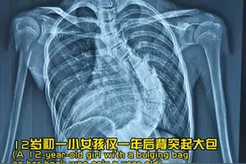 12岁女孩脊柱侧弯，“拉直”脊柱后，身高接近1米80 发现#脊柱侧弯 仅仅一年，随着青春期孩子身高进入“猛涨期”，侧弯度数也随之飙升；视频封面