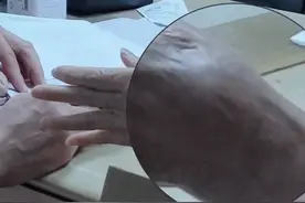 手臂用力血管就鼓起，家属和患者很焦急#专业的事交给专业的人 #血管鼓起来 #血管 #患者 #健康守护计划视频封面