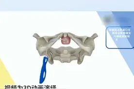 无张力尿道悬吊术3D动画 #女性尿失禁 #女性 #尿失禁 #尿失禁手术视频封面