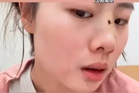 女子撞到推拉门鼻骨骨折 医生建议手术， 结果消肿后变高鼻梁 美出新高度，医生：骨折处有增生使鼻梁变高视频封面