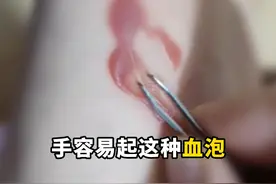 手上、脚上不小心被挤出#淤血泡 ，千万别用手挤！试试这样处理#血泡 #医学科普 #脆皮大学生 #外伤视频封面