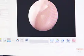 耳朵里有积液，就像在水底听声音 #同仁张娜 #医学科普 #硬核健康科普行动视频封面