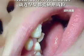 6岁女童吃得太精细，长出“双排牙” #医学科普 #牙齿🦷 #硬核健康科普行动视频封面