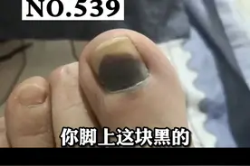 脚趾甲长了块黑印子，是身体健康出了问题吗？#科普 #指甲 #健康 视频封面