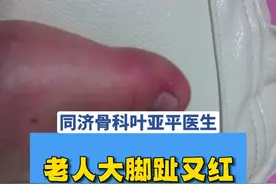 老人大脚趾有红又肿,跟上次骨折没关系,痛风发了! #医学科普 #大脚趾又红又肿 #脚趾肿痛 #痛风 #硬核健康科普行动视频封面
