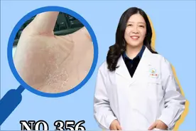 #皮肤健康手掌皲裂，又痒又疼，常年反复发作，#皲裂性湿疹 可以这样处理。#手脚干裂 视频封面