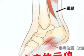 脚底疼的元凶找到了，足底筋膜炎！ #足底筋膜炎 #脚疼 #科普 #涨知识视频封面