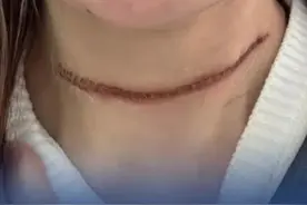 #女生被割喉组委会免责协议或无效 【95后姑娘骑行比赛被风筝线“割喉”，承办方称赛前签了《免责协议》，律师：免责条款无效】近日，江苏南京一位95后女生小姜参加自行车比赛，骑行过程中被赛道上的风筝线“割喉”，伤口长约15厘米。小姜就诊后CT显示挫伤，没有割到声带等部位。当天急诊共花费200多元，小姜与承办方沟通伤情后，承办方将急诊费转予小姜，并额外转给小姜500元赔偿。受伤三天后，伤口开始结疤、变得明显，医生诊断为皮肤裂伤，需要涂消炎药、护理药等，总计花费近千元。小姜再次与承办单位工作人员进行沟通，对方答复她“走保险”，但小姜对此并不认可。（扬子晚报）视频封面