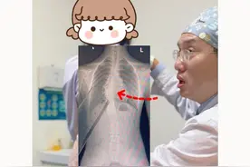 不遵医嘱，半年侧弯复查 反而加重！ #青少年脊柱侧弯 #脊柱侧弯孙新志 #硬核健康科普行动  #入冬换季不患疾 #年度健康知识干货大赏视频封面