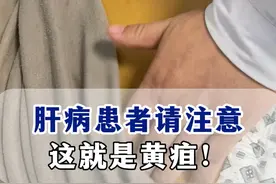 肝病患者请注意，这就是黄疸！ 黄疸是一种直观的症状。患者血液中胆红素水平异常升高，导致皮肤、巩膜及黏膜等部位呈现黄色。
胆红素是红细胞分解后的产物，它会被肝脏处理并通过胆道系统排出体外。然而，当这一过程受阻时，胆红素就会在体内积累，引发黄疸。肝炎、肝硬化、胆道梗阻、溶血性疾病等都可能是导致成人黄疸的元凶。这些疾病不仅影响胆红素的正常代谢，还可能对全身多个系统造成损害。因此，成人一旦发现黄疸症状，应立即就医，查明原因，对症治疗。
#乙肝 #肝病 #黄疸 #作品同步头条赢激励 #硬核健康科普行动视频封面