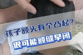孩子额头有个凸起，很可能是额缝早闭！ #额缝早闭 #颅缝早闭 #儿童脑科小米大夫 #硬核健康科普行动视频封面