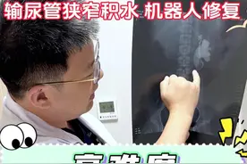 重复肾合并马蹄肾，高难度的狭窄修复#机器人手术 #输尿管狭窄 #肾积水 #重复肾 #硬核健康科普行动视频封面