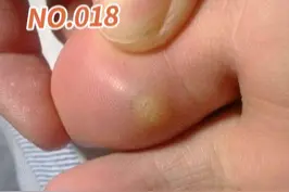 脚底长小硬结，你以为长的是鸡眼，其实还可能是跖疣#跖疣 #皮肤 #医学科普 视频封面