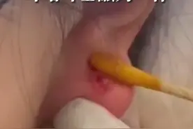 看着都痛！女孩打耳洞60天后耳堵耳垂融为一体#打耳洞视频封面