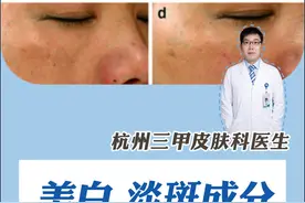 氨甲环酸为什么是公认的美白成分，揭秘它的前世今生！ 氨甲环酸在临床上应用流行经历了一系列变化：
1950年——凝血作用被发现
日本药物学家冈本歌子在研究止血药的过程中发现，氨甲环酸的止血效果良好，是氨基己酸（EACA）的27倍，自此开启氨甲环酸向药用凝血剂方向的发展，在历经多年之后，其得发挥凝血的医用价值且延续至今，临床上仍在使用。
1979——发现可以减少黑色素生成
日本女医生二条贞子在用氨甲环酸治疗慢性荨麻疹时，意外发现患者脸上的黄褐斑居然消退了。这不仅引起了医学界的极大轰动，也推动了氨甲环酸在治疗色斑以及色素沉着方面的应用。从1998年开始，口服氨甲环酸在临床上被用于治疗色斑和色素沉着。
2005年——美白淡斑作用运用于化妆品
2005年日本和中国台湾地区公布氨甲环酸可作为美白和淡斑成分，同年，资生堂开始把这一成分使用在美白化妆品中。近些年来，随着更多学者的深入研究，氨甲环酸在皮肤科中的应用经久不衰。
现将氨甲环酸在皮肤科的应用：
1.黄褐斑
2.炎症后色素沉着
3.痤疮相关炎症后红斑
4.毛细血管扩张症
5.玫瑰痤疮
6.皮肤自然衰老和光老化
7.美白
#硬核健康科普行动     #听医生一句劝  #樊哥撩皮肤   #双十一  #黄褐斑视频封面