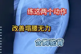 睡前五分钟 练这两个动作 改善塌腰无力 含胸驼背 #耸肩驼背 #塌腰无力 #含胸驼背 #抖出健康知识宝藏  #用健康的方式做不健康的事视频封面