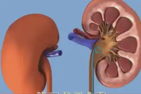 结石术后大家最关注的几个问题以及术后的预防 #肾结石 #输尿管狭窄 #微创手术 #结石预防 #硬核健康科普行动视频封面