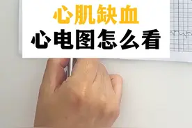 一张心电图是无法判断心肌缺血的#医学科普 #心电图 #心肌缺血视频封面