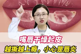 嘴唇的死皮不要撕！加重唇炎，会反复发作#唇炎 #嘴唇脱皮 #嘴唇干燥 #剥脱性唇炎 #医学科普视频封面