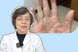 女性单个手掌干燥脱皮 、有红斑，又疼又痒，这是真菌感染导致的#手癣 ，要尽早治疗！#鹅掌风 #皮肤 #医学科普 #女性视频封面