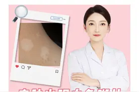 皮肤出现白色斑片，别怕，不一定是白癜风 #抖音知识年终大赏 #汗斑 #花斑癣视频封面