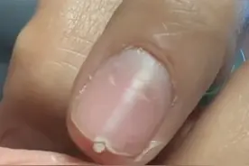 女生长出双层指甲啥原因?  “不吃绿叶菜 不吃牛羊肉”。来源@拉克姐姐吸踢🖐🏻 #指甲 #美甲 #女生 #挑食视频封面