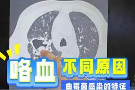 咯血的原因又很多，而这个患者是因为#曲霉菌感染 #肺健康 #呼吸与危重症医学科 #呼吸科江城医生 #硬核健康科普行动视频封面