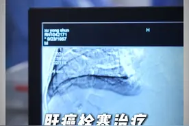 肝癌栓塞治疗：为生命续航的时间桥梁！ #昆明市第三人民医院视频封面