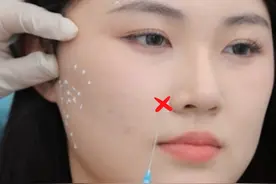 填完鼻基底总移位？这个方法自然不馒化 #鼻基底 #张云飞医生 #鼻基底填充 #苹果肌提升 #馒化脸视频封面
