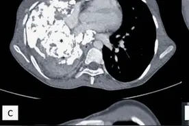 炎性肌纤维母细胞瘤的临床特点，预后，最新的治疗方法视频封面